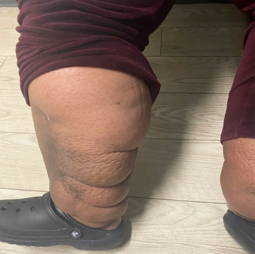 patient with severe leg swelling due to lymphedema