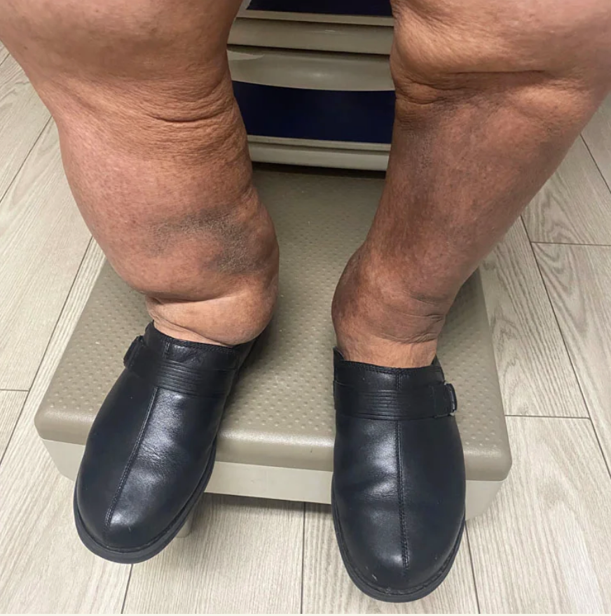massive reduction in leg size of lymphedema patient after using Aero-Wrap compression sleeve