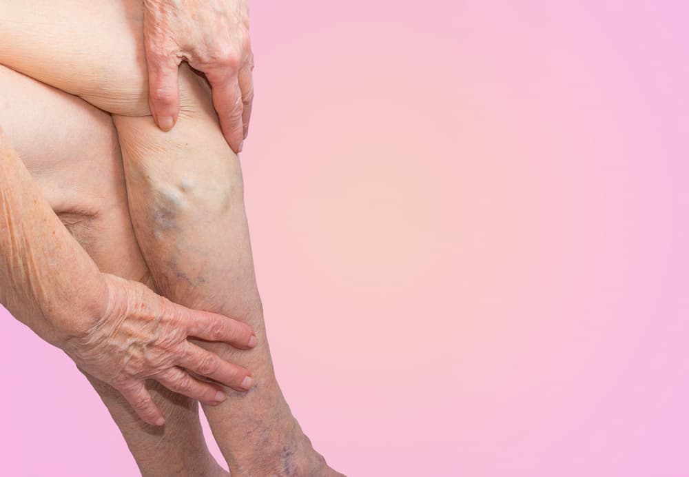Is Chronic Venous Insufficiency Curable?