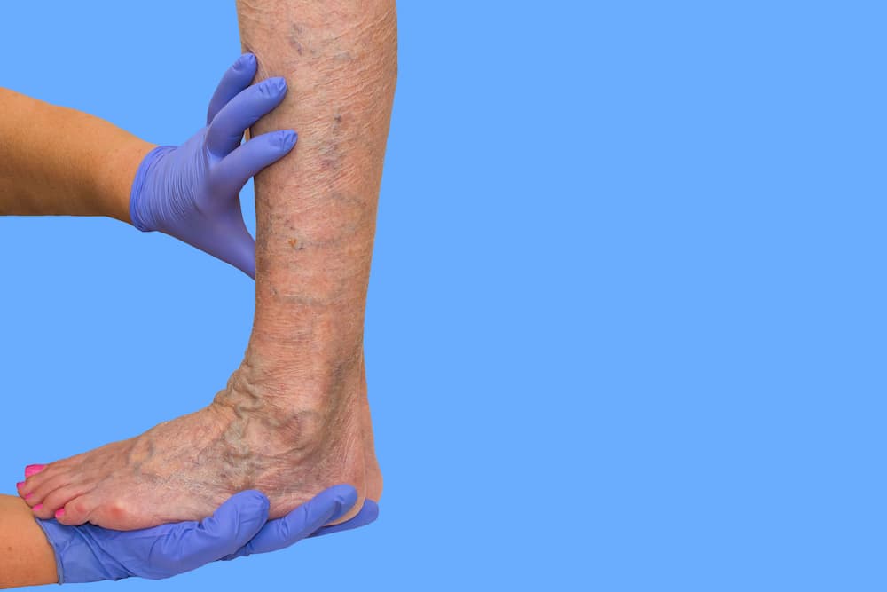 what causes chronic venous insufficiency and how Aero-Wrap can help