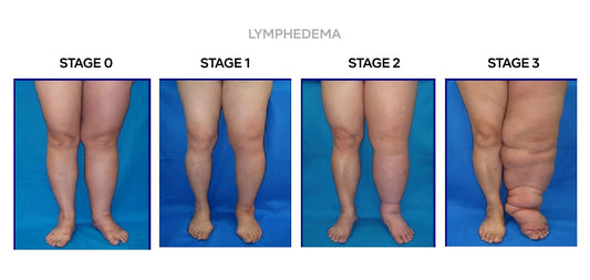 Understanding Lymphedema Staging and the Importance of Early Detection