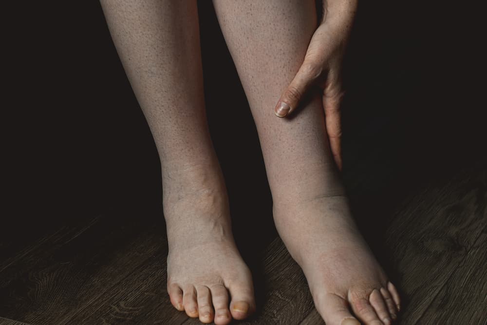 Lymphedema in the Feet: Causes, Symptoms, Treatment, and More