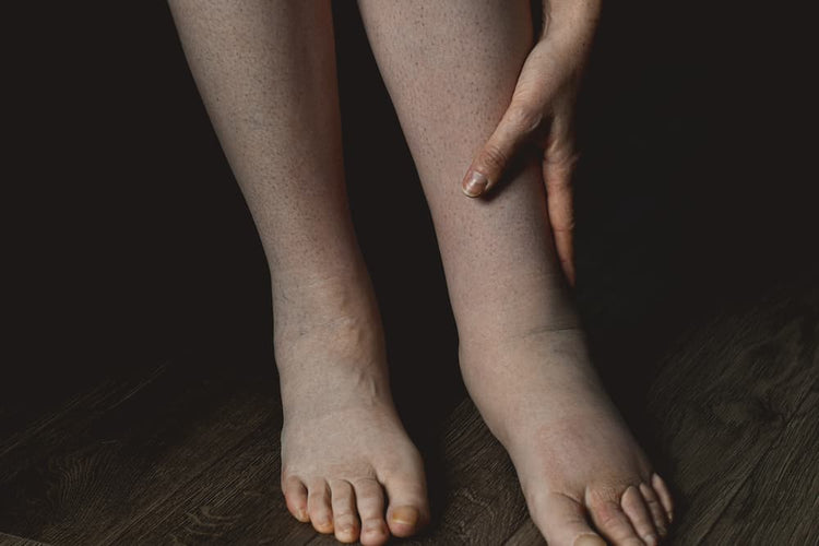 Lymphedema in the Feet Causes, Symptoms, Treatment, and More Sun