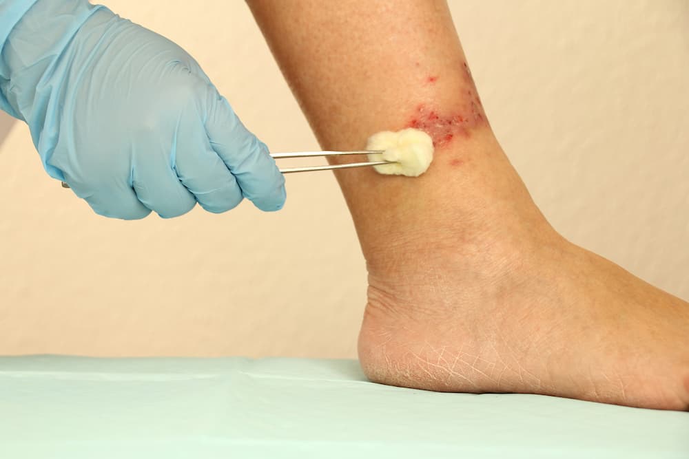 revolutionary treatment for venous leg ulcers