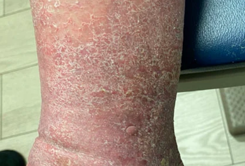 Cvi Back Rash Science – Sun Scientific