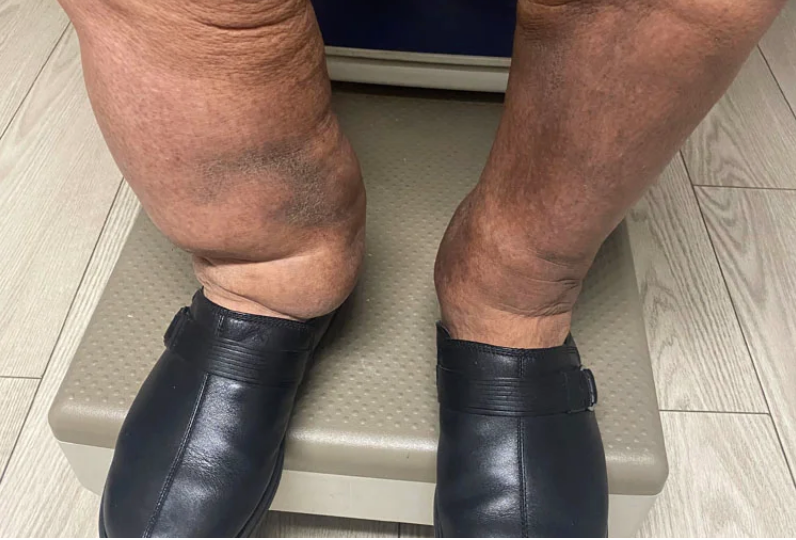 lymphedema leg swelling greatly reduced using Aero-Wrap leg compression wraps
