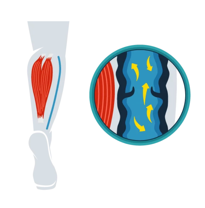 chronic venous insufficiency