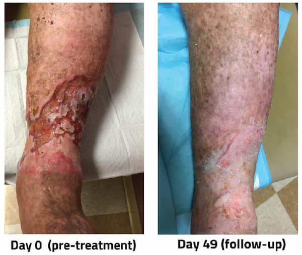 healing a venous leg ulcer using aero-wrap before and after images