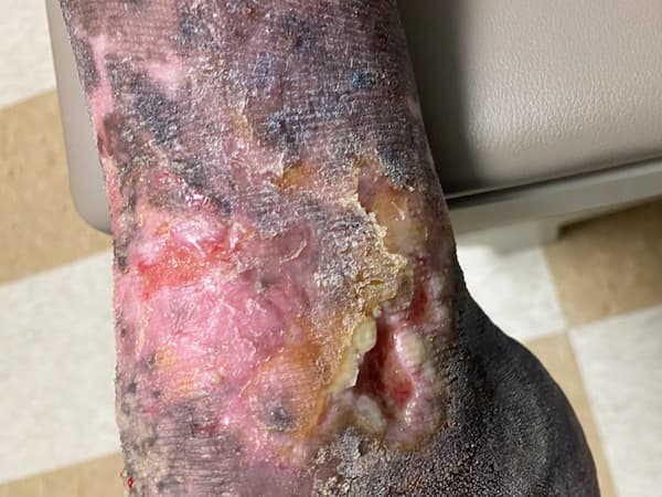 healing a venous leg ulcer using aero-wrap