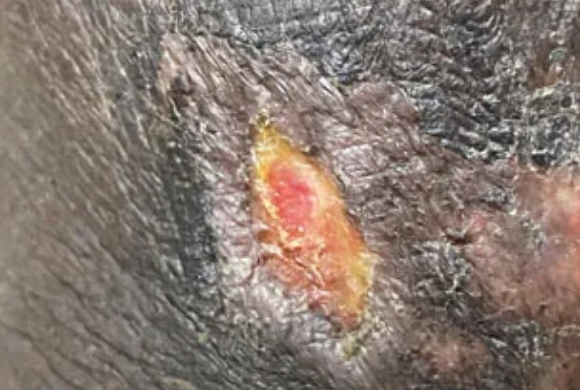 severe venous leg ulcers has already begun to heal using Aero-Wrap gradient compression system