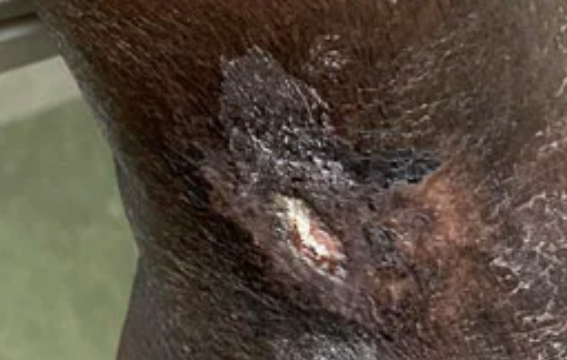 venous leg ulcer showing advanced healing after only 3 weeks using Aero-Wrap and AeroBolster