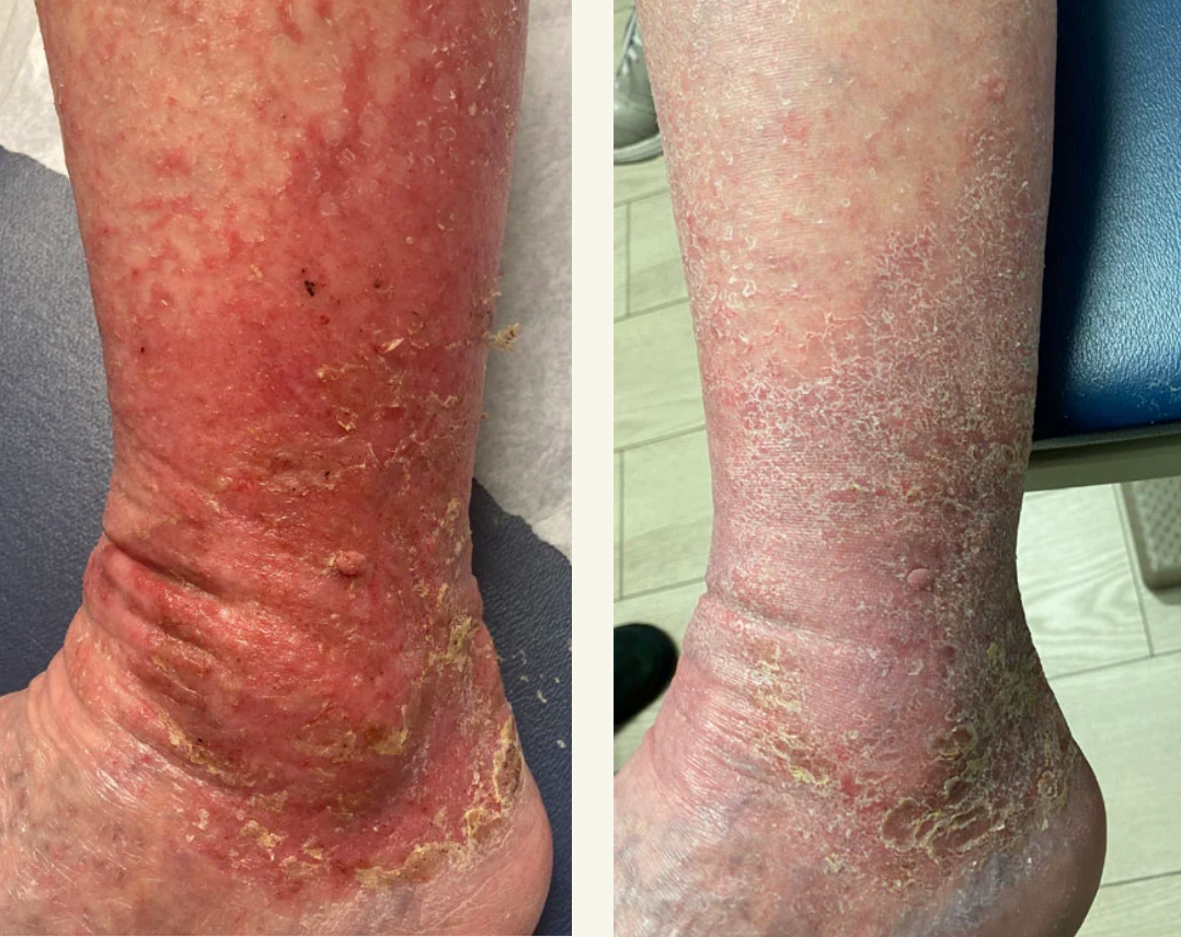 before and after image of chronic venous insufficiency skin changes following use of Aero-Wrap air compression wrap